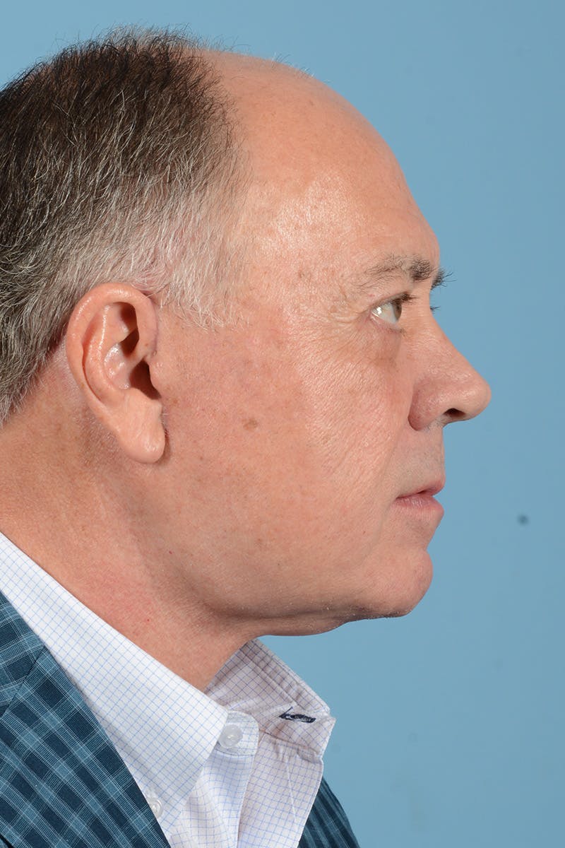 Facelift Before & After Gallery - Patient 196139 - Image 6