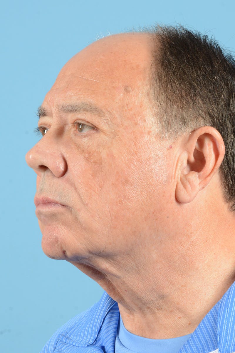 Facelift Before & After Gallery - Patient 196139 - Image 7