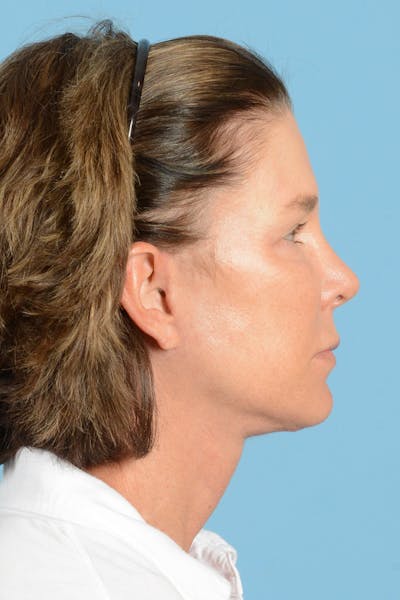 Facial Augmentation Before & After Gallery - Patient 324671 - Image 6