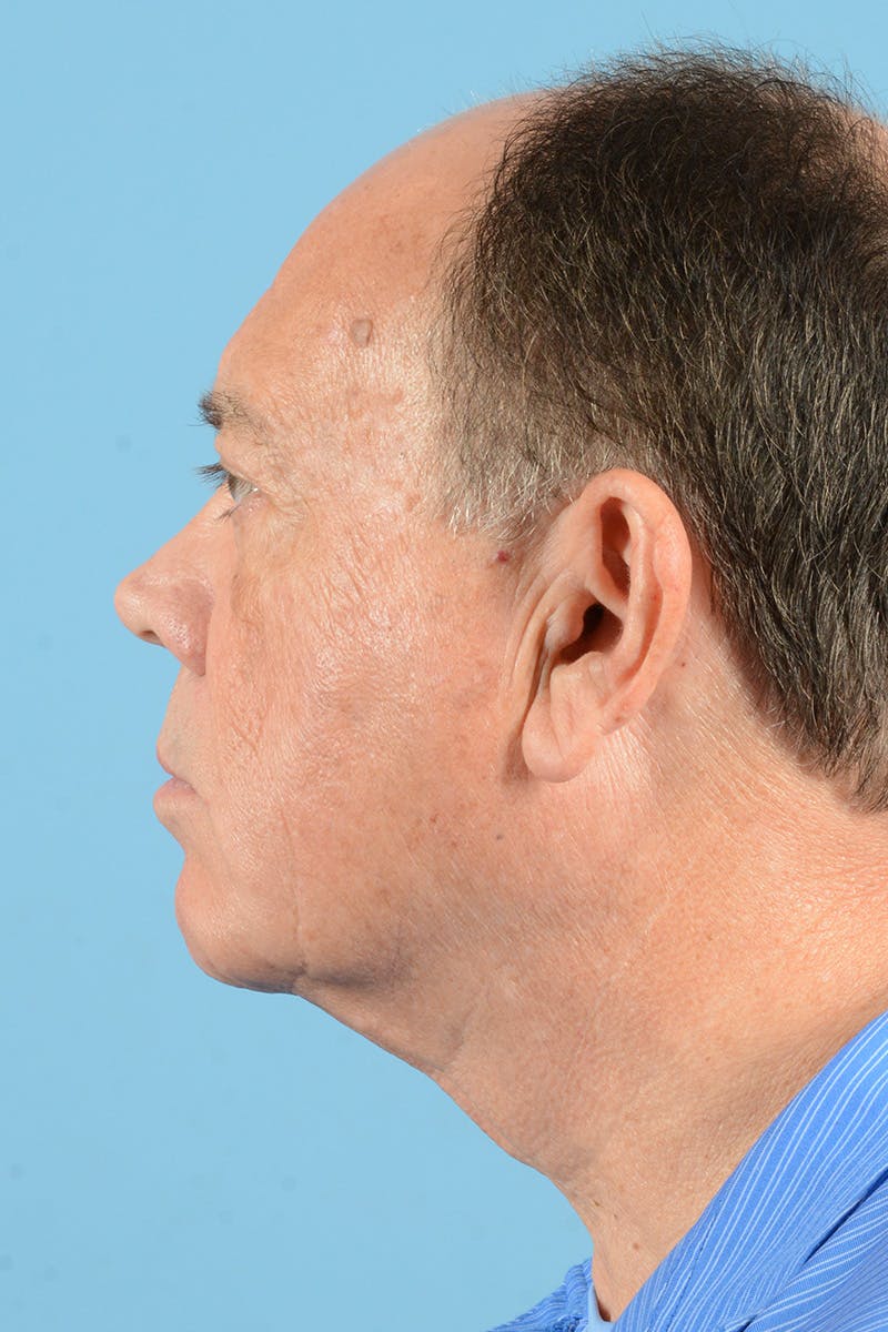 Facelift Before & After Gallery - Patient 196139 - Image 9