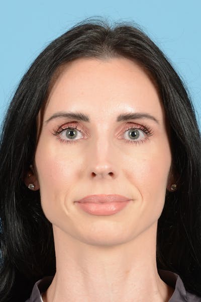 Rhinoplasty Before & After Gallery - Patient 148840 - Image 1