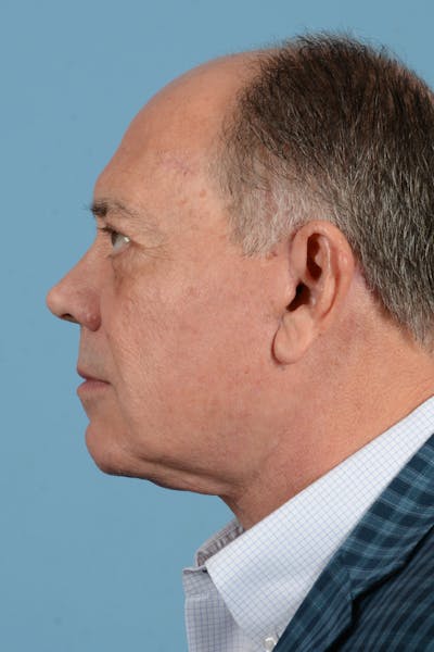 Facelift Before & After Gallery - Patient 196139 - Image 10