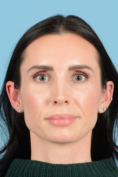 Rhinoplasty Before & After Gallery - Patient 148840 - Image 2