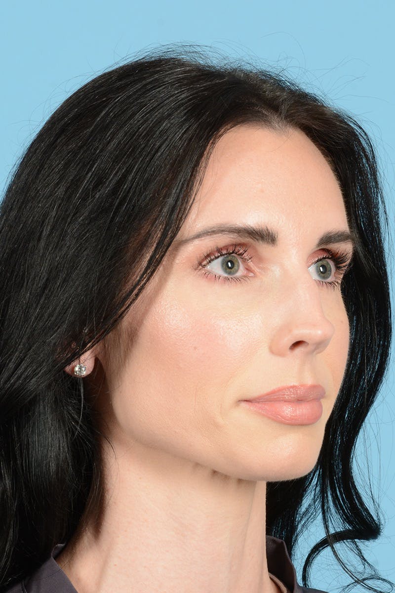 Rhinoplasty Before & After Gallery - Patient 148840 - Image 3