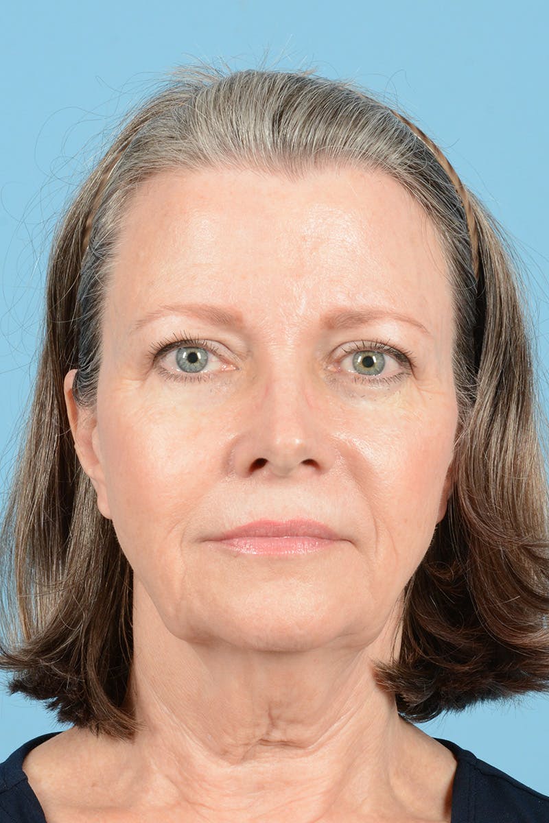 Facelift Before & After Gallery - Patient 407703 - Image 1