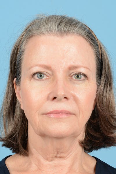 Facelift Before & After Gallery - Patient 407703 - Image 1