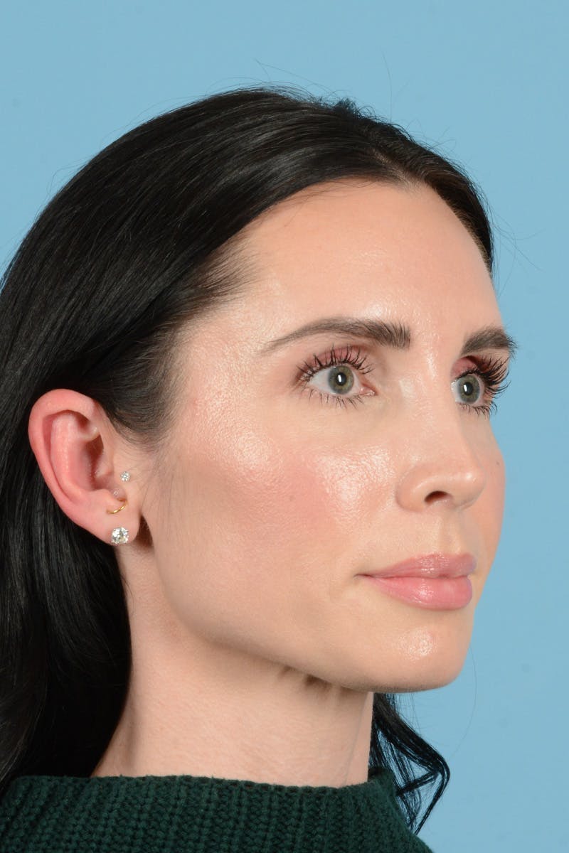 Rhinoplasty Before & After Gallery - Patient 148840 - Image 4