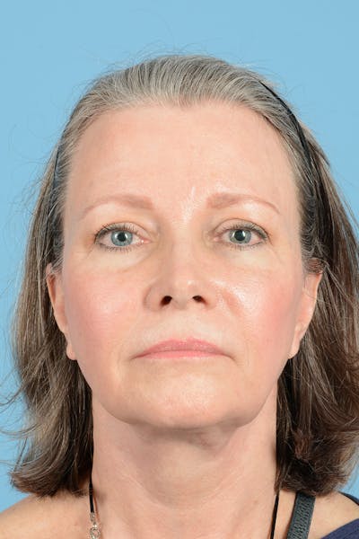 Facelift Before & After Gallery - Patient 407703 - Image 2