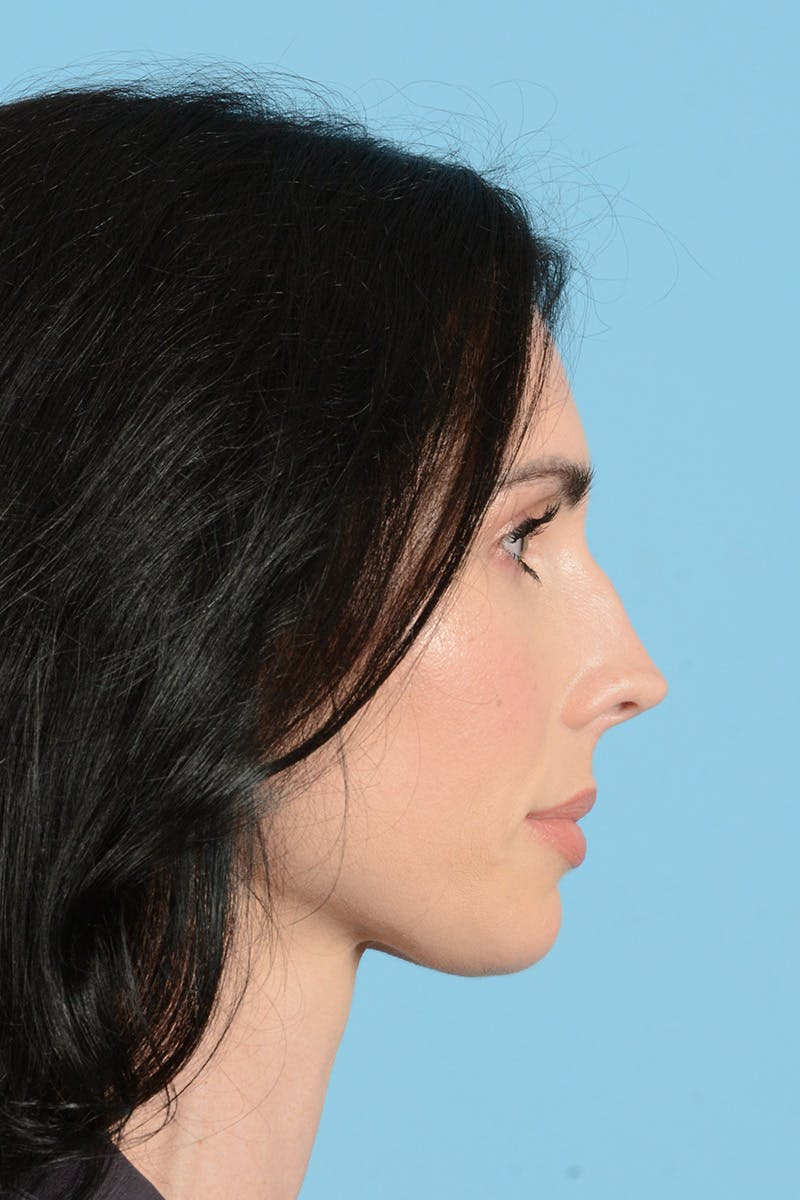 Rhinoplasty Before & After Gallery - Patient 148840 - Image 5