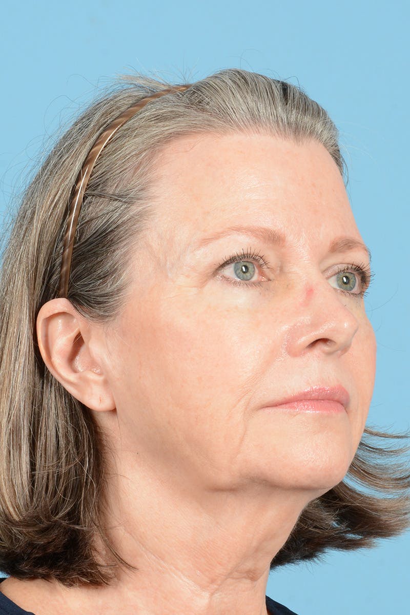 Facelift Before & After Gallery - Patient 407703 - Image 3