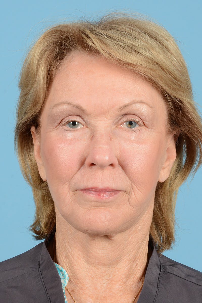 Facial Augmentation Before & After Gallery - Patient 207603 - Image 2