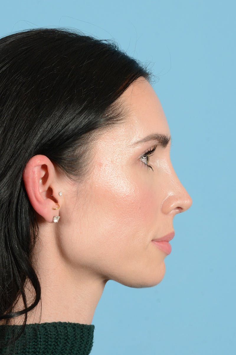 Rhinoplasty Before & After Gallery - Patient 148840 - Image 6