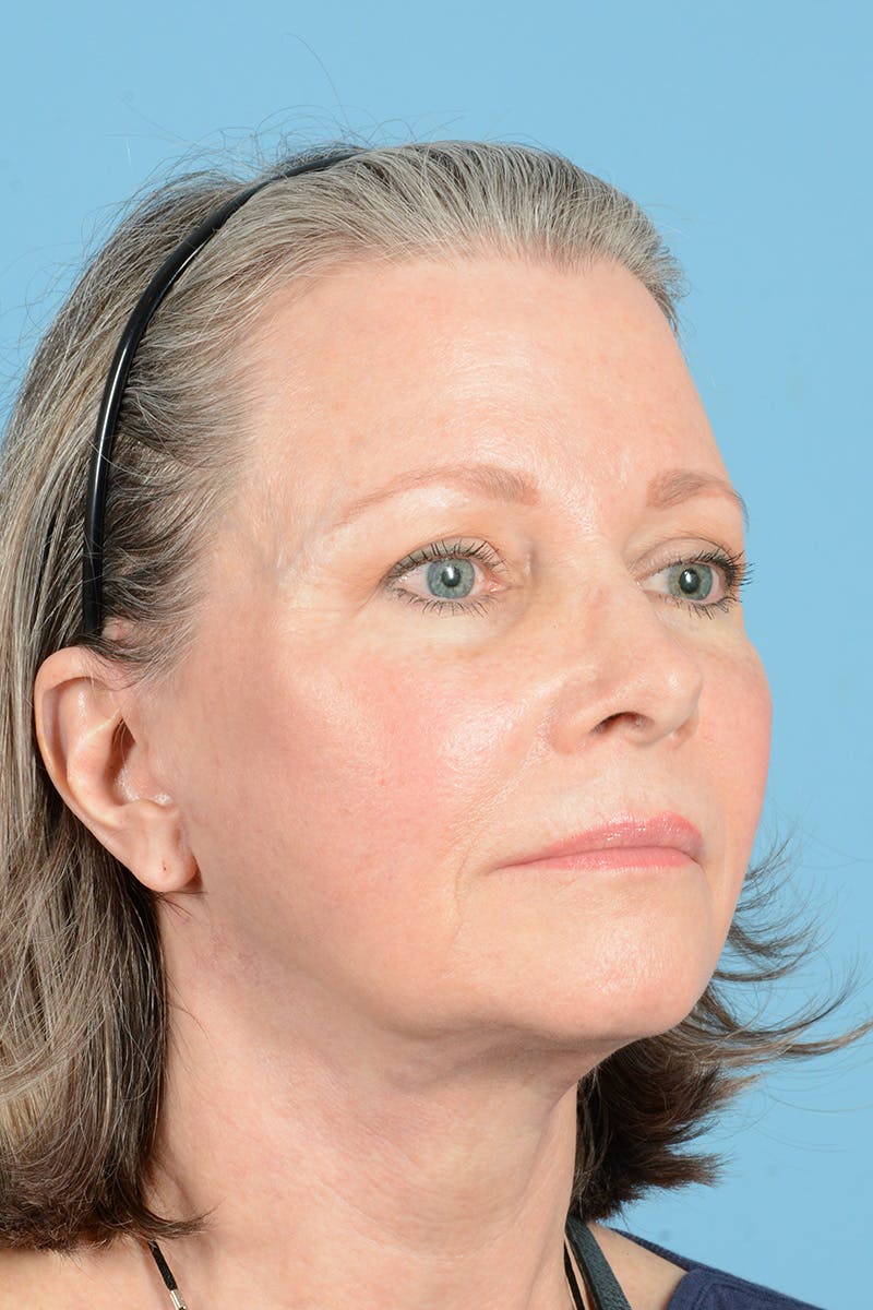 Facelift Before & After Gallery - Patient 407703 - Image 4