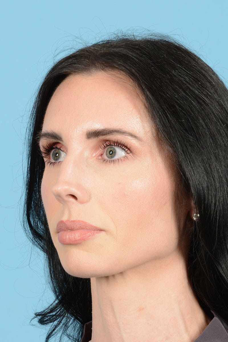 Rhinoplasty Before & After Gallery - Patient 148840 - Image 7