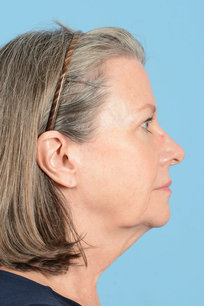Facelift Before & After Gallery - Patient 407703 - Image 5