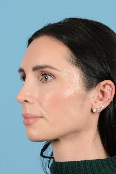 Rhinoplasty Before & After Gallery - Patient 148840 - Image 8