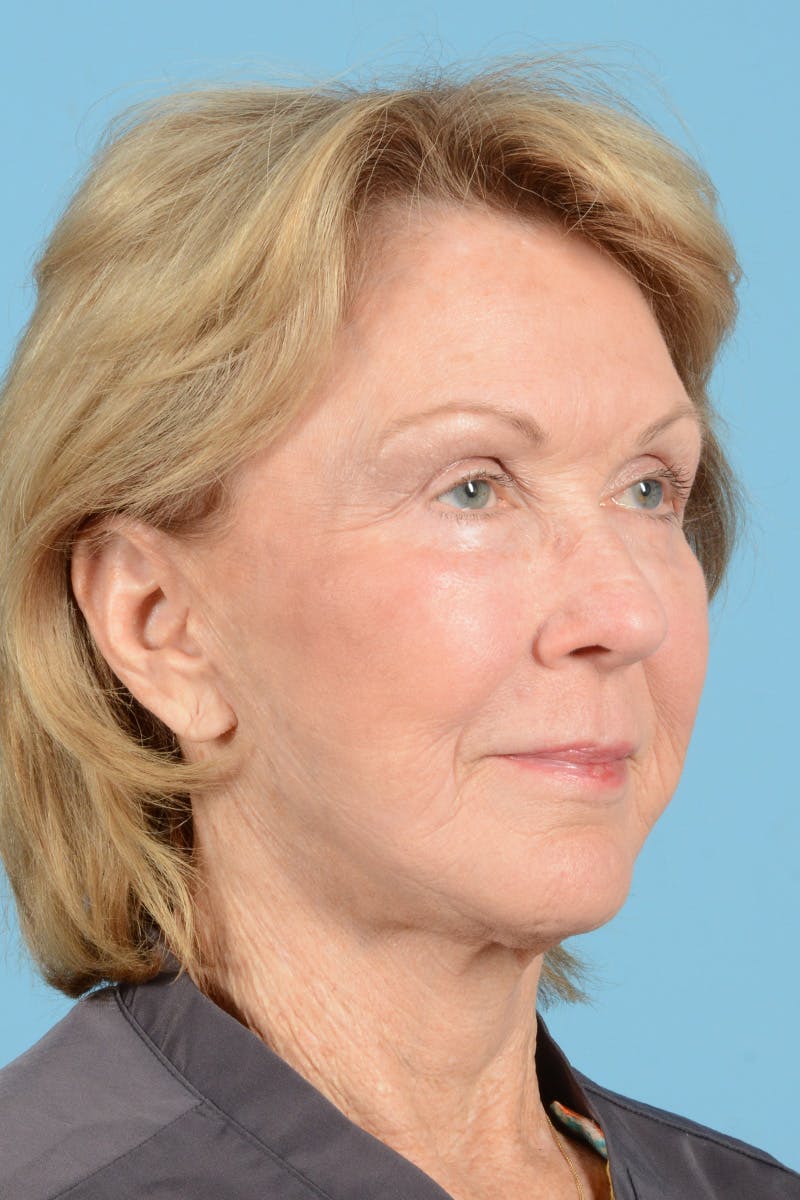 Facial Augmentation Before & After Gallery - Patient 207603 - Image 4