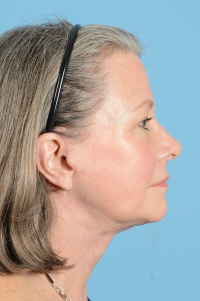 Facelift Before & After Gallery - Patient 407703 - Image 6