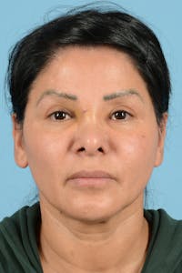 Eyelid Lift Before & After Gallery - Patient 831777 - Image 1