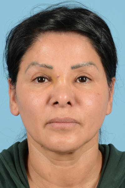 Eyelid Lift Before & After Gallery - Patient 831777 - Image 1