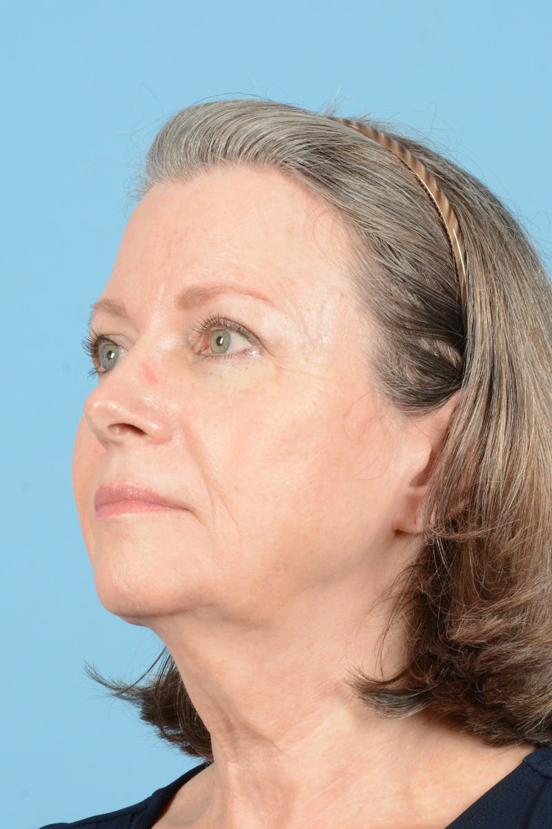 Facelift Before & After Gallery - Patient 407703 - Image 7