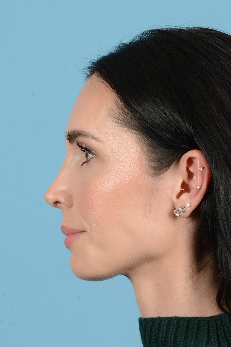Rhinoplasty Before & After Gallery - Patient 148840 - Image 10