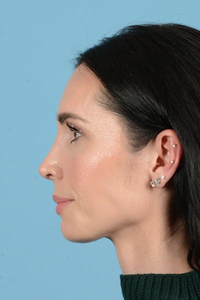 Rhinoplasty Before & After Gallery - Patient 148840 - Image 10