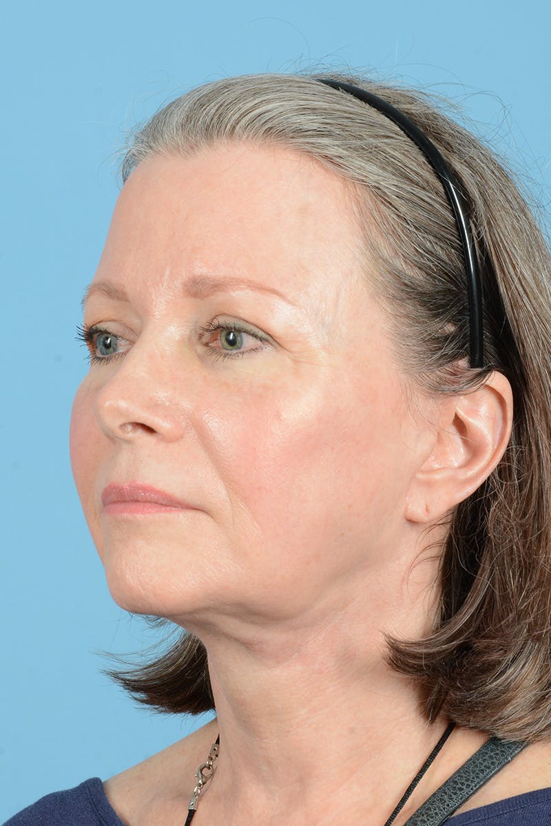 Facelift Before & After Gallery - Patient 407703 - Image 8