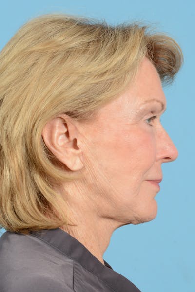Facial Augmentation Before & After Gallery - Patient 207603 - Image 6