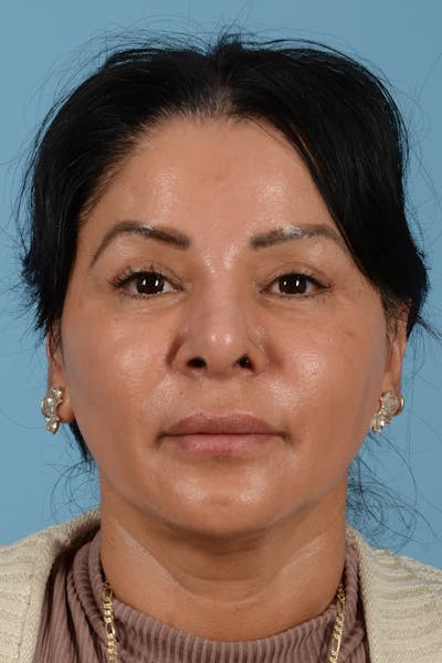 Eyelid Lift Before & After Gallery - Patient 831777 - Image 2