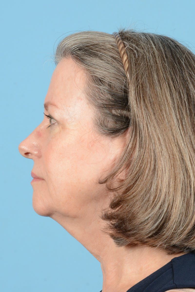 Facelift Before & After Gallery - Patient 407703 - Image 9