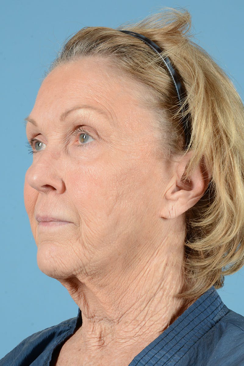 Facial Augmentation Before & After Gallery - Patient 207603 - Image 7