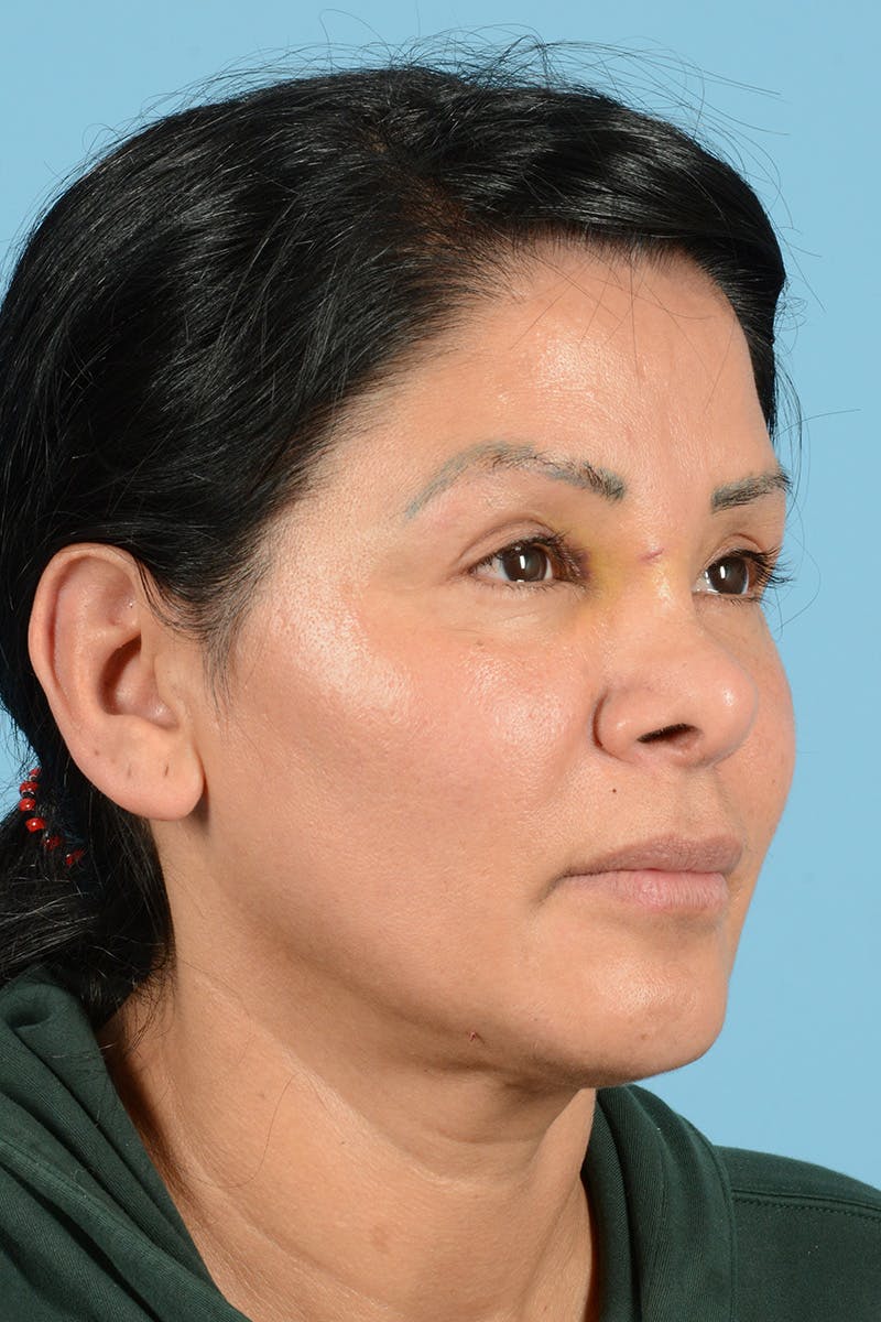 Eyelid Lift Before & After Gallery - Patient 831777 - Image 3