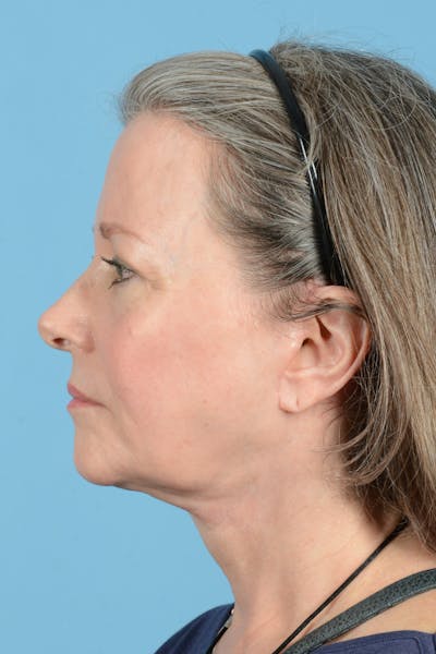 Facelift Before & After Gallery - Patient 407703 - Image 10