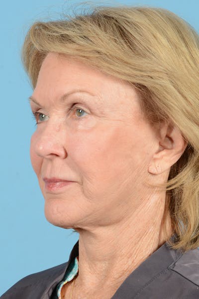 Facial Augmentation Before & After Gallery - Patient 207603 - Image 8