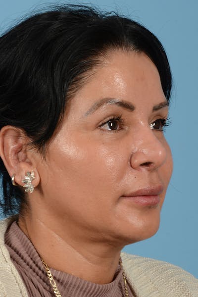 Eyelid Lift Before & After Gallery - Patient 831777 - Image 4