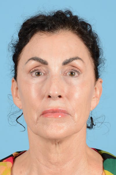 Facelift Before & After Gallery - Patient 318562 - Image 1