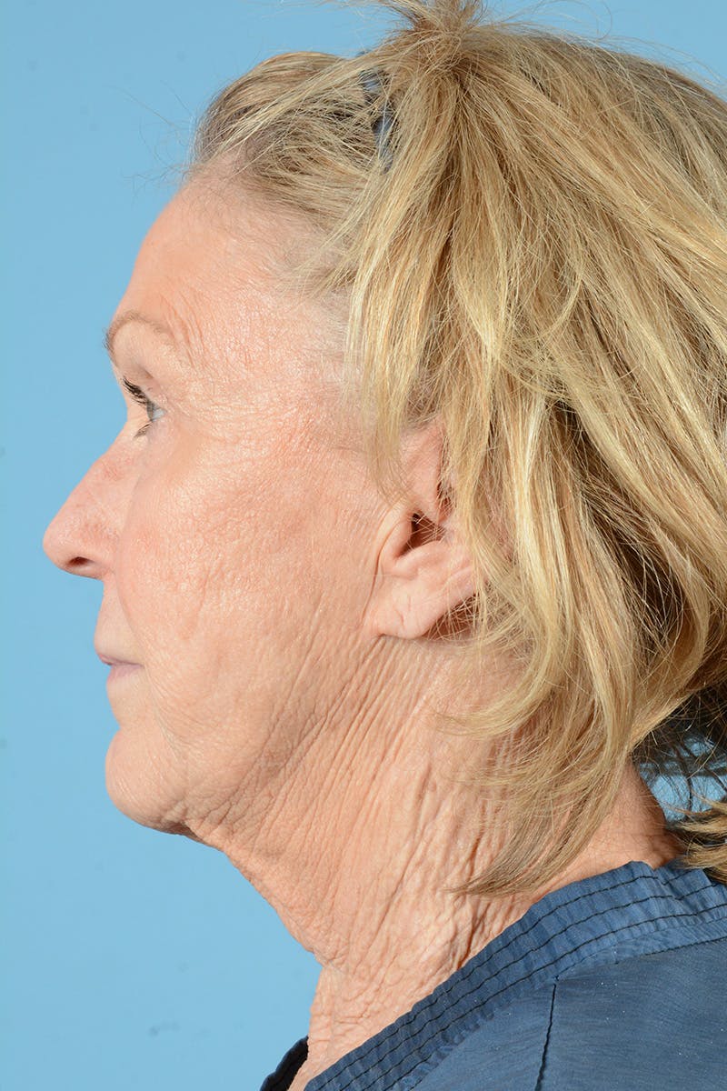 Facial Augmentation Before & After Gallery - Patient 207603 - Image 9