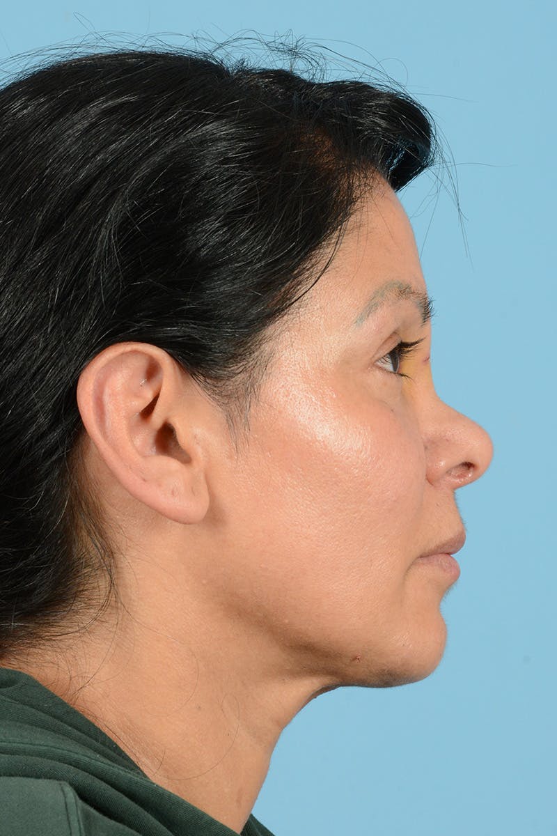 Eyelid Lift Before & After Gallery - Patient 831777 - Image 5