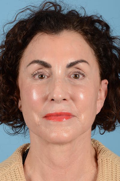 Facelift Before & After Gallery - Patient 318562 - Image 2