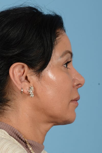 Eyelid Lift Before & After Gallery - Patient 831777 - Image 6