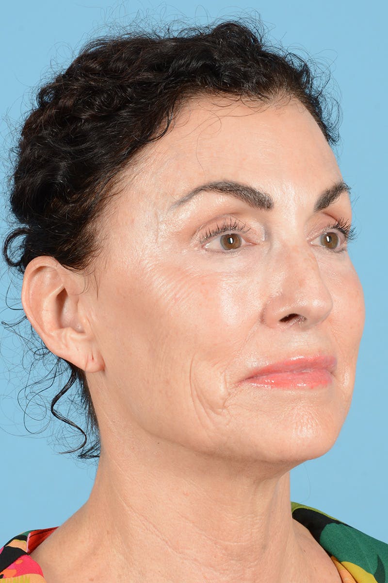 Facelift Before & After Gallery - Patient 318562 - Image 3