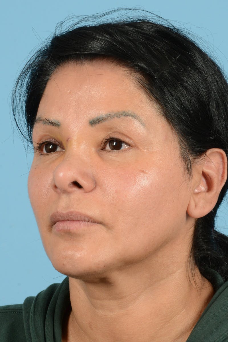 Eyelid Lift Before & After Gallery - Patient 831777 - Image 7
