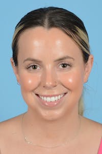 Facial Augmentation Before & After Gallery - Patient 316455 - Image 1