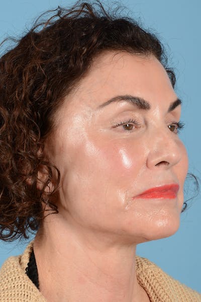 Facelift Before & After Gallery - Patient 318562 - Image 4
