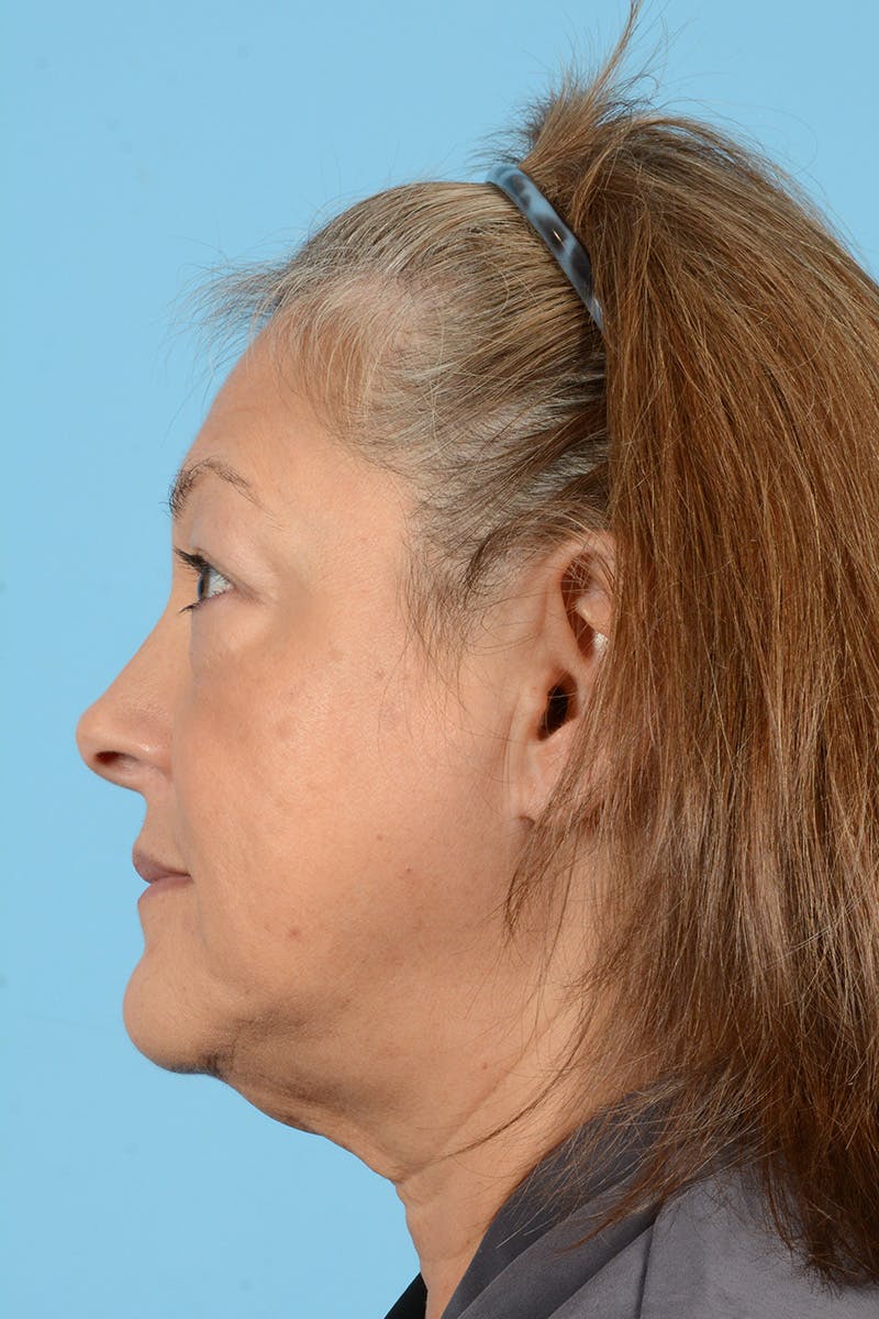 Rhinoplasty Before & After Gallery - Patient 421578 - Image 7