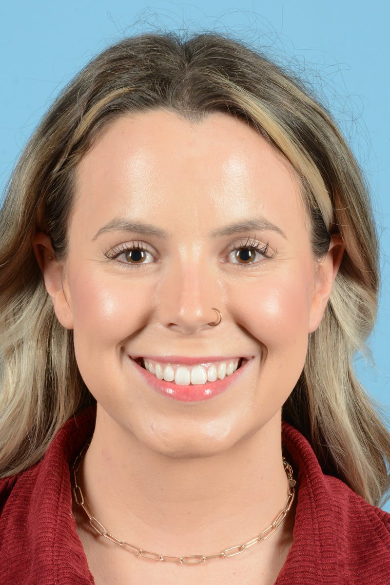 Facial Augmentation Before & After Gallery - Patient 316455 - Image 2