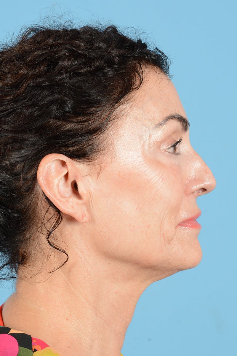Facelift Before & After Gallery - Patient 318562 - Image 5