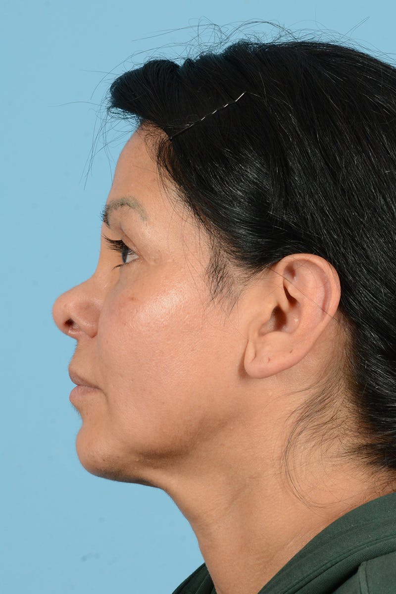 Eyelid Lift Before & After Gallery - Patient 831777 - Image 9