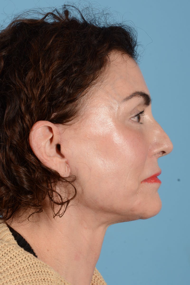 Facelift Before & After Gallery - Patient 318562 - Image 6